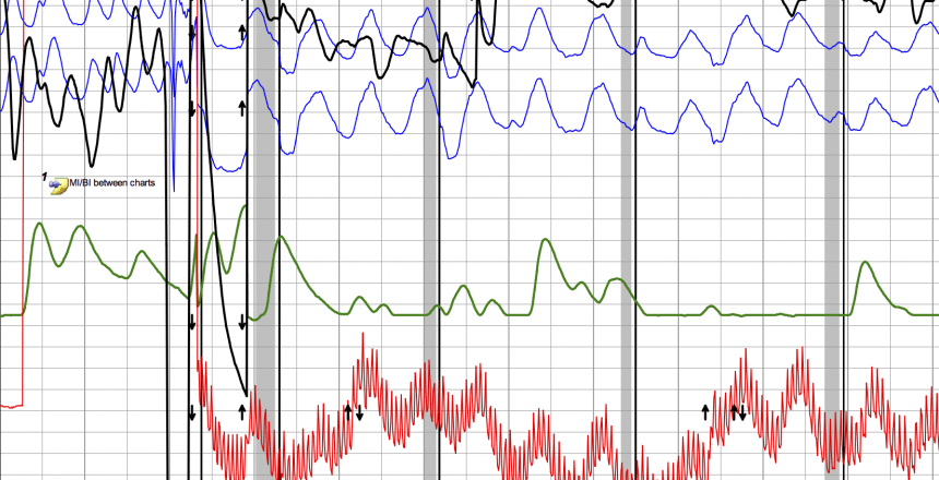 polygraph reading chart